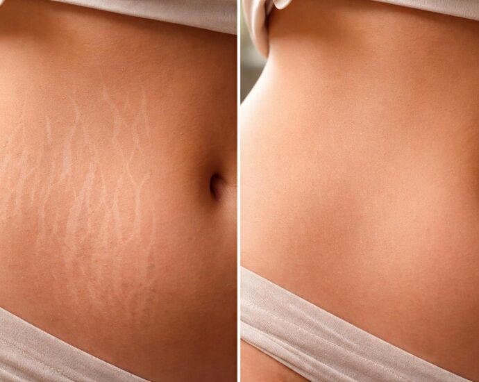 découvrez comment le microneedling et le dermaroller agissent contre les vergetures avec des résultats avant/après impressionnants qui vont vous surprendre.