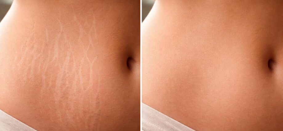 découvrez comment le microneedling et le dermaroller agissent contre les vergetures avec des résultats avant/après impressionnants qui vont vous surprendre.