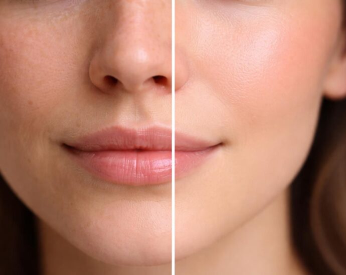 découvrez les véritables résultats du microneedling à travers des photos avant-après et comprenez l'efficacité de cette technique pour améliorer votre peau.