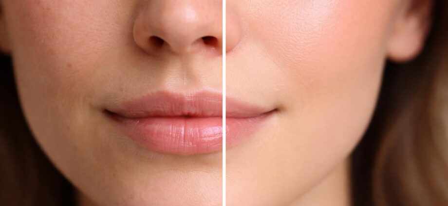 découvrez les véritables résultats du microneedling à travers des photos avant-après et comprenez l'efficacité de cette technique pour améliorer votre peau.